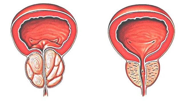 Prostatitis an normal Prostata