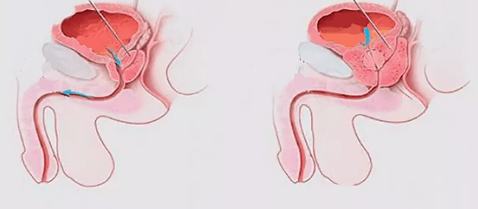 Unzeeche vun Prostatitis a Männer