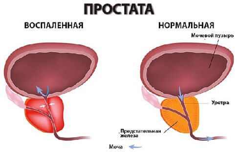 prostaten