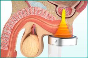 Behandlung vum Prostatitis