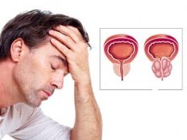 Prostatitis an engem Mann
