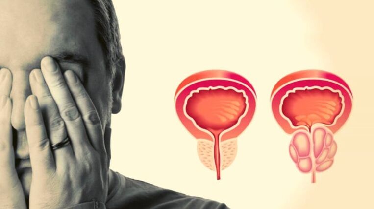 E Mann huet Prostatitis