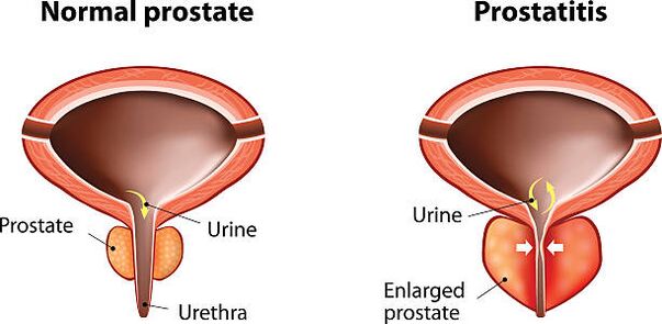 normal an entzündegt Prostata