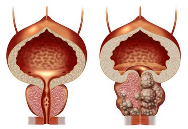 gesond Prostata a Prostataadenom