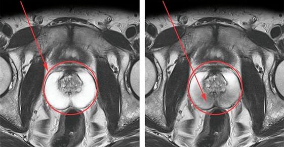 Normal Prostata (lénks) an Entzündung vun der Prostata mat Prostatitis (riets)